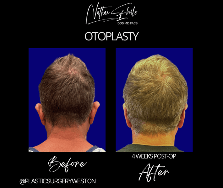 Otoplasty before and after case 6, actual patient at Weston Center for Plastic Surgery