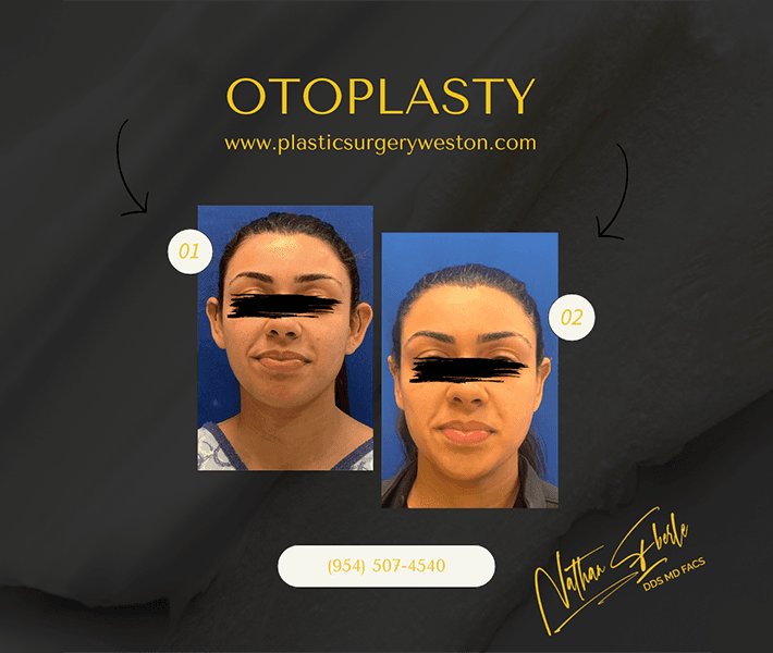 Otoplasty before and after case 7, actual patient at Weston Center for Plastic Surgery