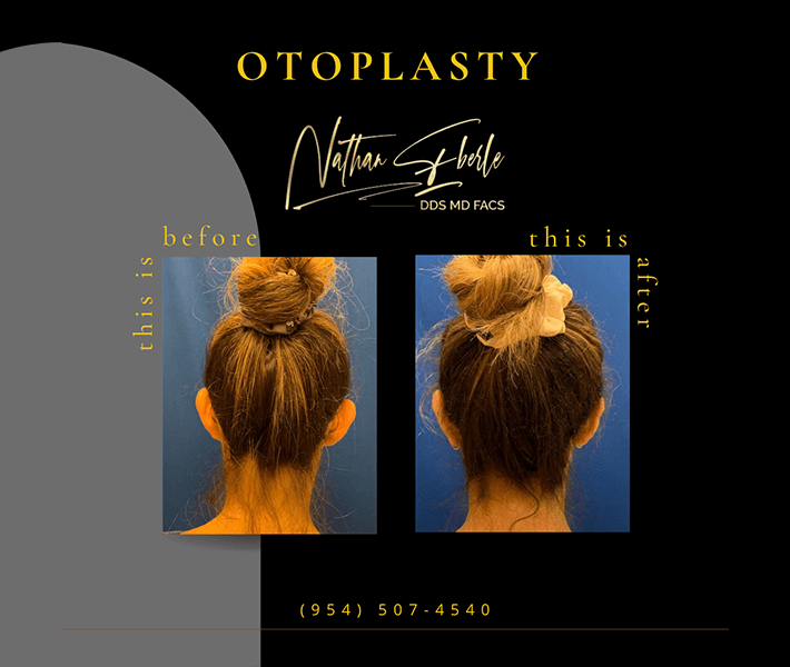 Otoplasty before and after case 9, actual patient at Weston Center for Plastic Surgery