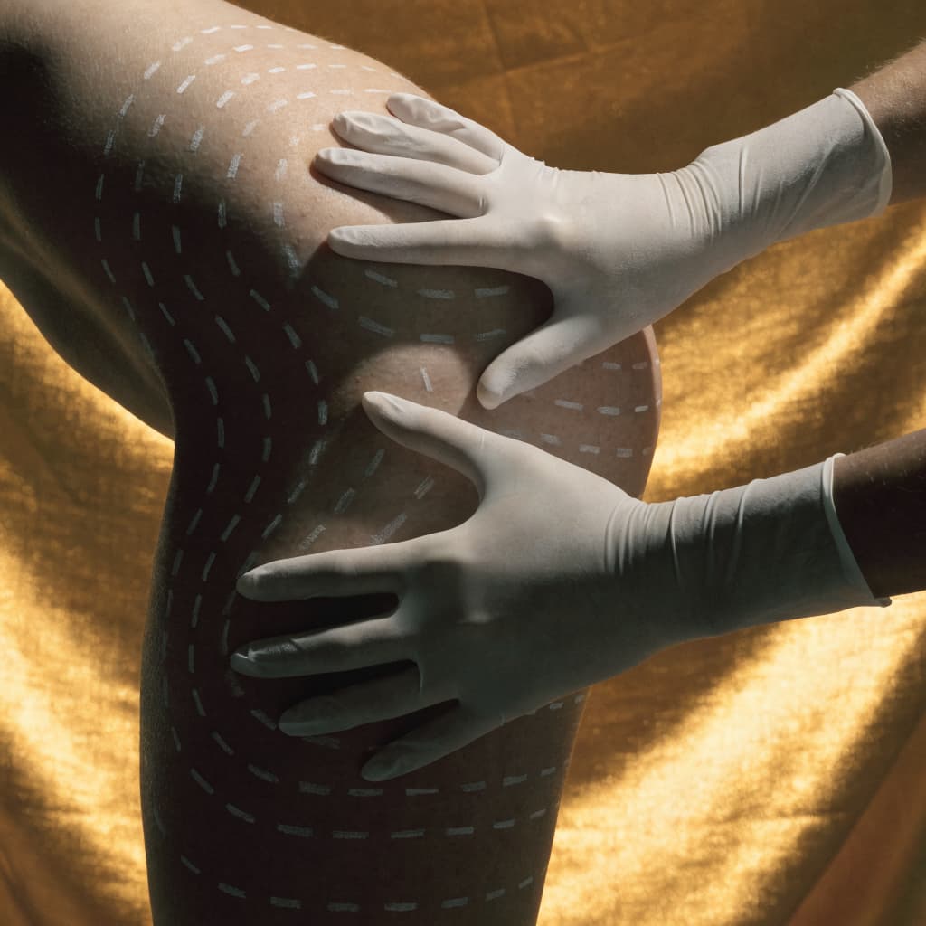 Fat Grafting & Fat Transfer