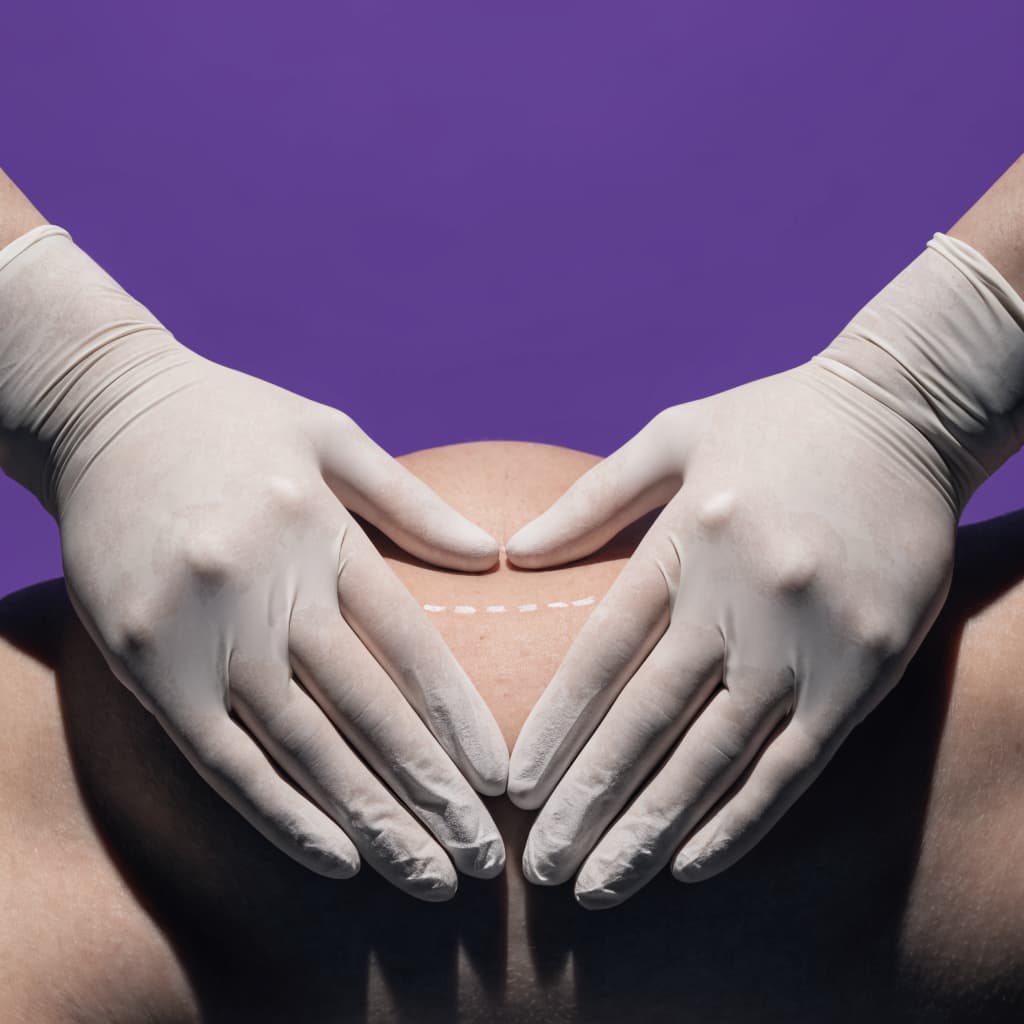 Mini Tummy Tuck