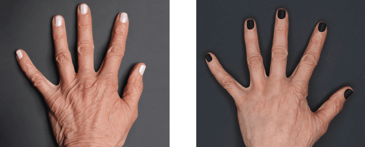 Renuva before and after, age 63