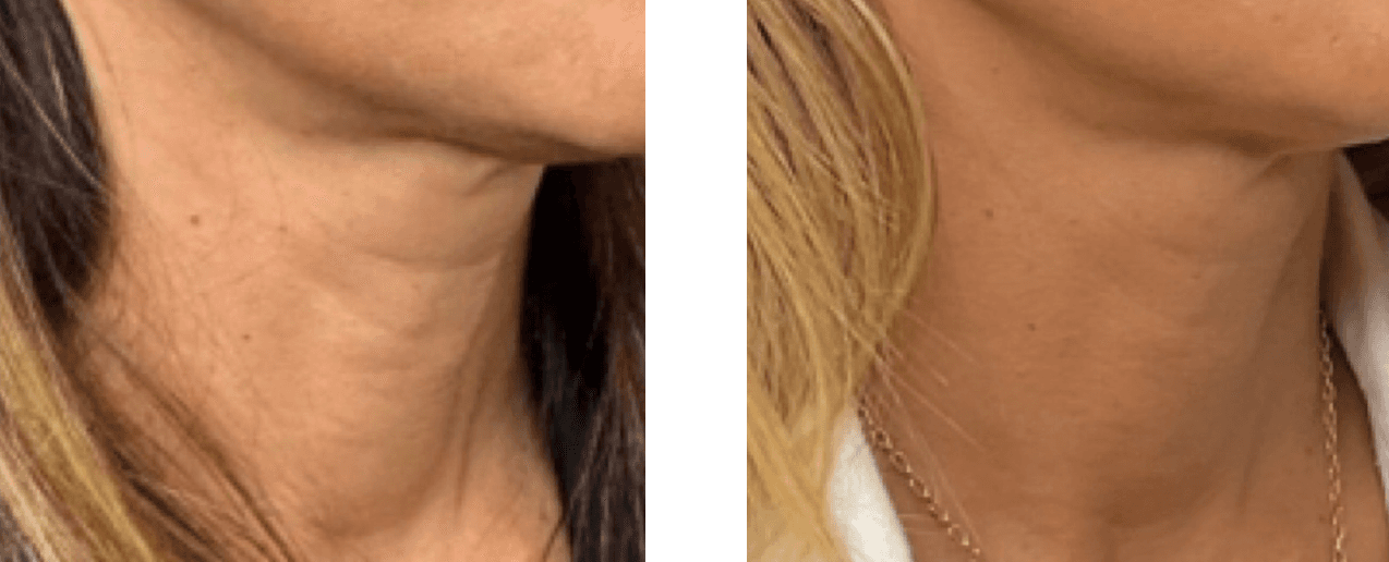 Renuva before and after, age 52