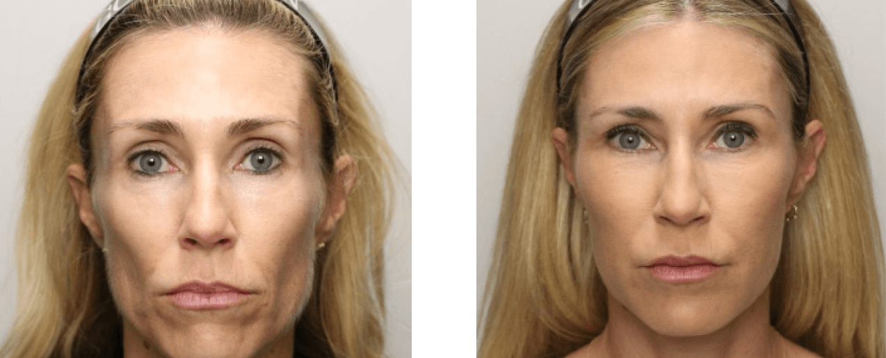 Renuva before and after, age 43