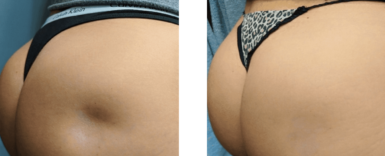 Renuva before and after, age 24
