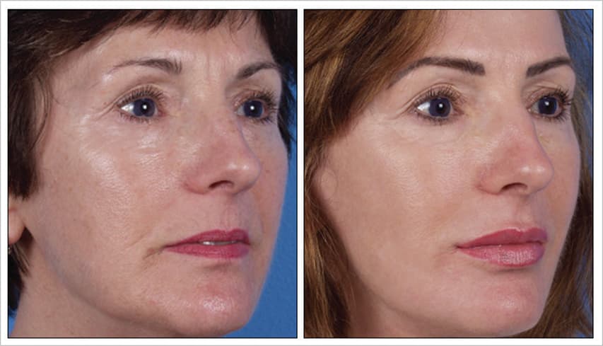 Post 1 Treatment | Photos Courtesy of J. David Holcomb, MD