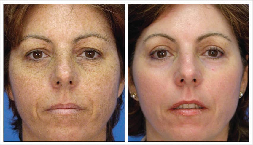 5 Months Post 1 Treatment | Photos Courtesy of Jason Pozner, MD, FACS