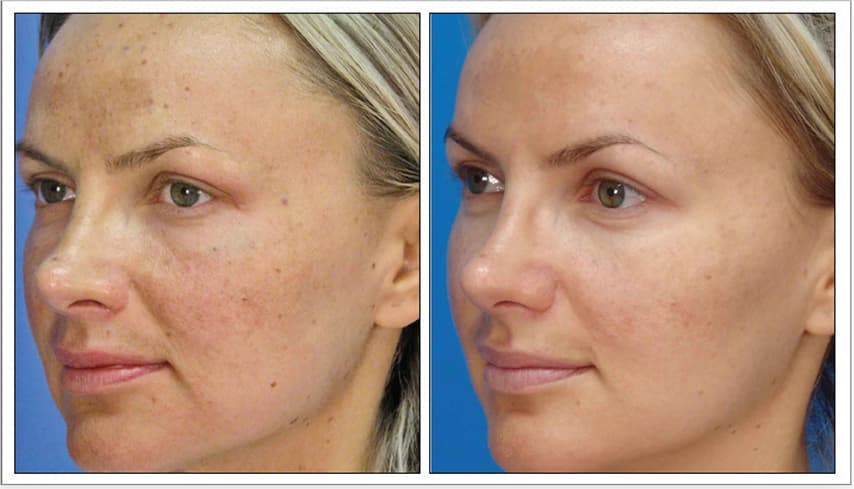 9 Months Post 2 Treatments | Photos Courtesy of Jason Pozner, MD, FACS