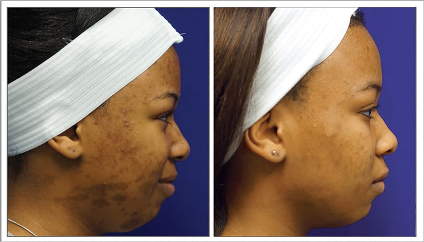 Post 4 Treatments | Photos Courtesy of Jeff Walding, MD