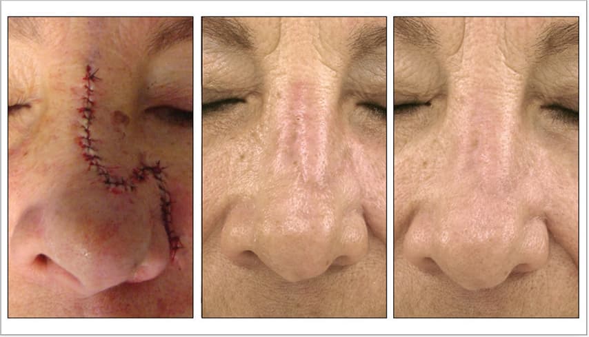 3 Months Post 2 Treatments | Photos Courtesy of Joel L. Cohen, MD