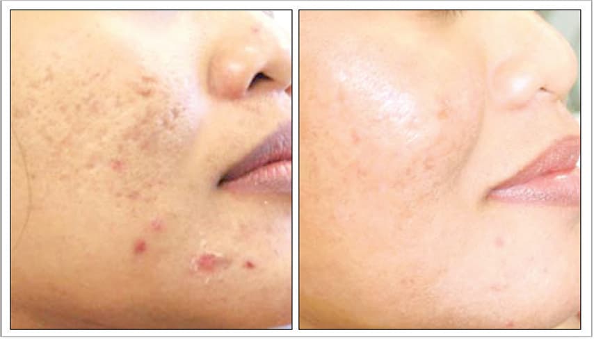 Post 3 Treatments | Photos Courtesy of Todd Bessinger, MD, PhD