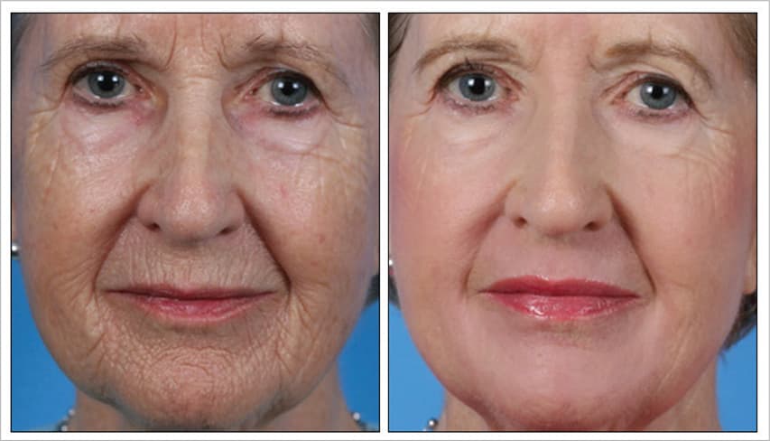 Post 1 Treatment | Photos Courtesy of J. David Holcomb, MD