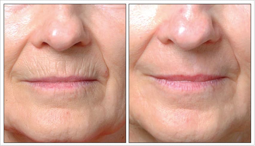 4 Months Post 1 Treatment | Photos Courtesy of Kent Remington, MD