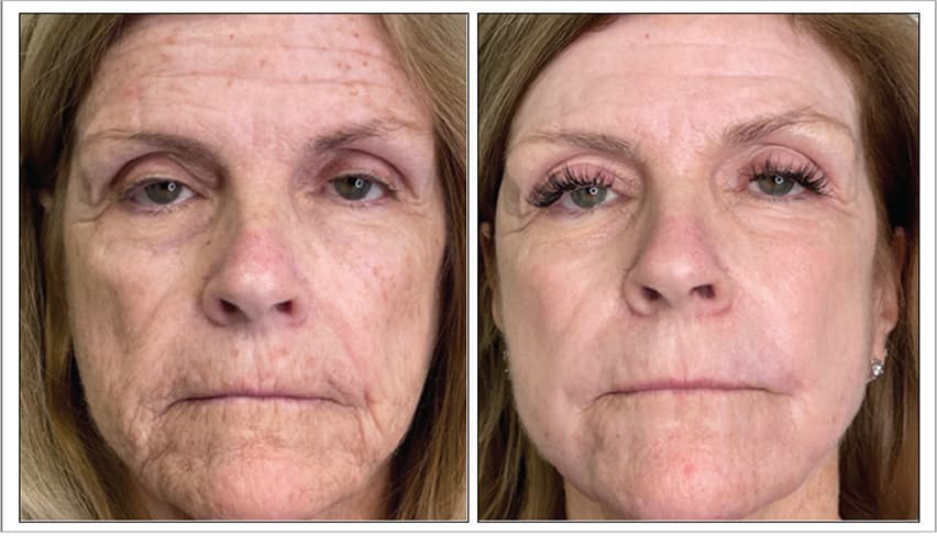 2 Months post 1 Treatment | Photos Courtesy of Lauren Saltzburg, DO