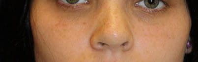 Rhinoplasty case 2 before and after results at Weston Center for Plastic Surgery