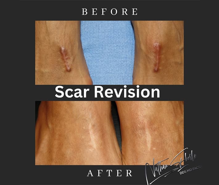 Scar Revision before and after case 1, actual patient at Weston Center for Plastic Surgery