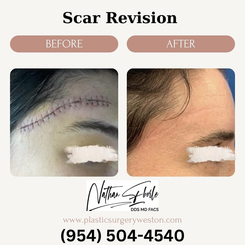 Scar Revision before and after case 2, actual patient at Weston Center for Plastic Surgery