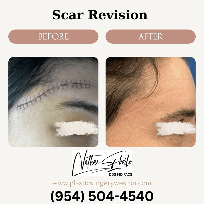Scar Revision before and after case 2, actual patient at Weston Center for Plastic Surgery