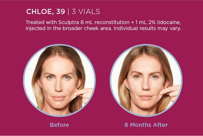 Sculptra before and 6 months after results for Chloe, age 39