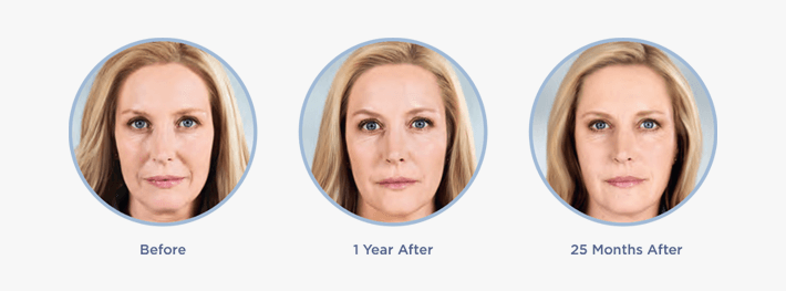 Sculptra before, 1 year after, and 25 months after results for a female patient