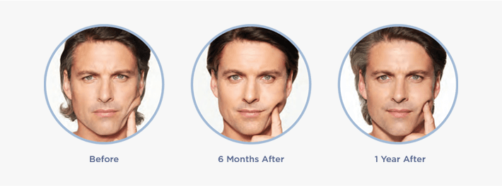 Sculptra before, 6 months after, and 1 year after results for a male patient
