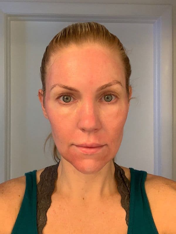 Shannon Ford two days after her Halo procedure