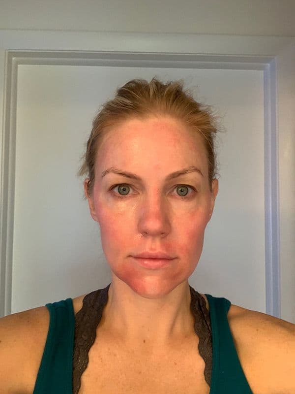 Shannon Ford three days after her Halo procedure