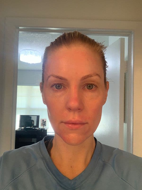 Shannon Ford five days after her Halo procedure