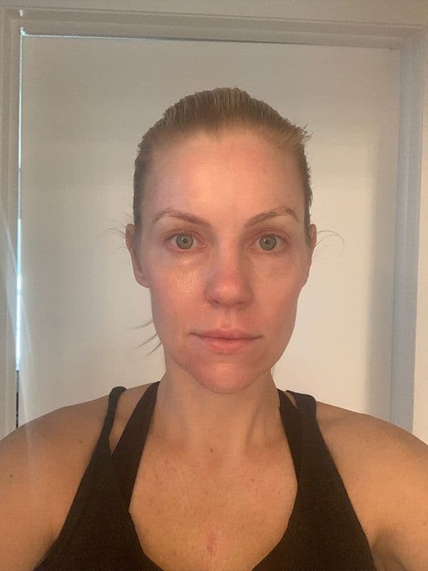 Shannon Ford six days after her Halo procedure