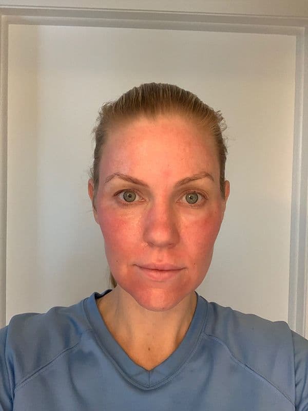 Shannon Ford the morning after her Halo procedure