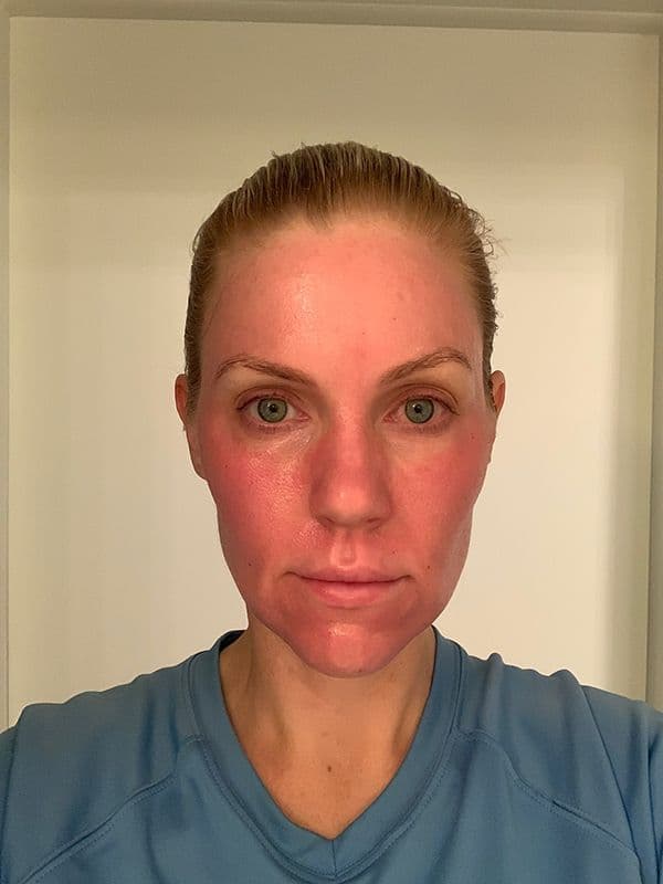 Shannon Ford the night of her Halo procedure
