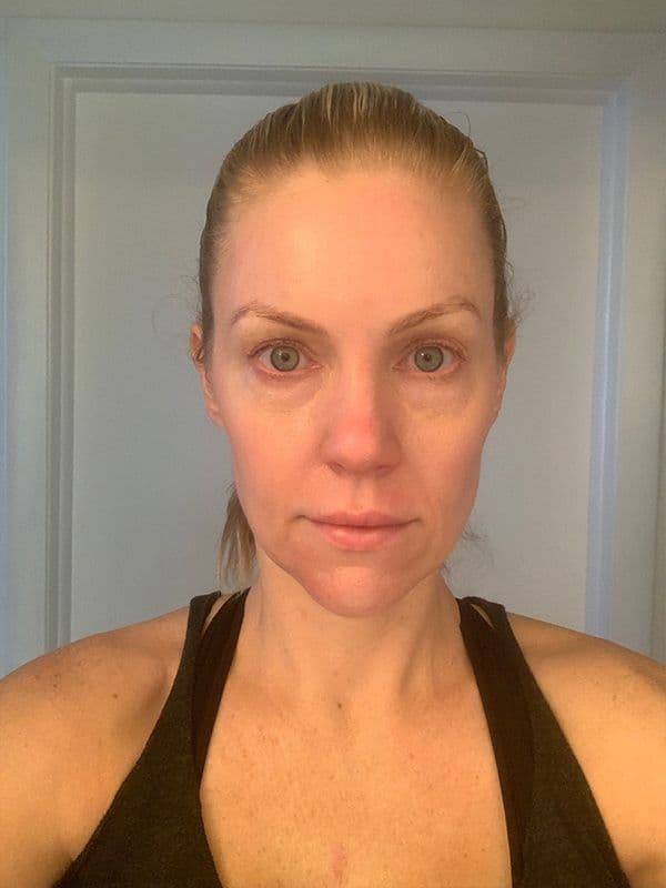 Shannon Ford one week after her Halo procedure