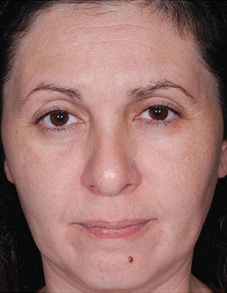 Skin case 1 after treatment