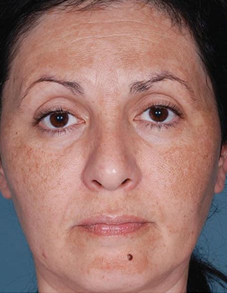 Skin case 1 before treatment
