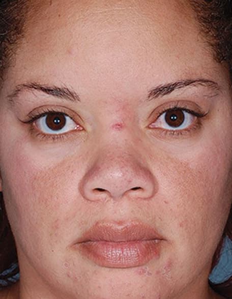 Skin case 2 after treatment