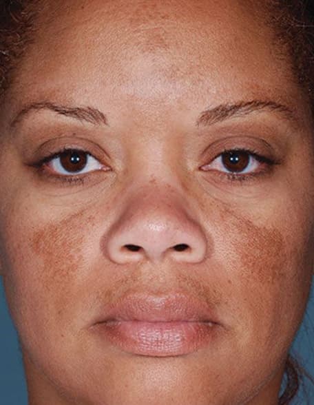 Skin case 2 before treatment