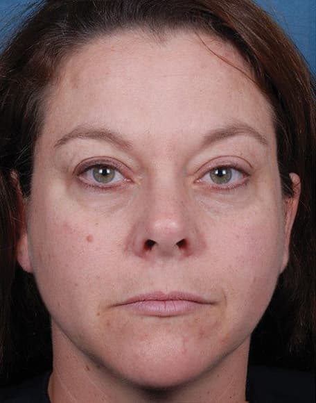 Skin case 3 after treatment