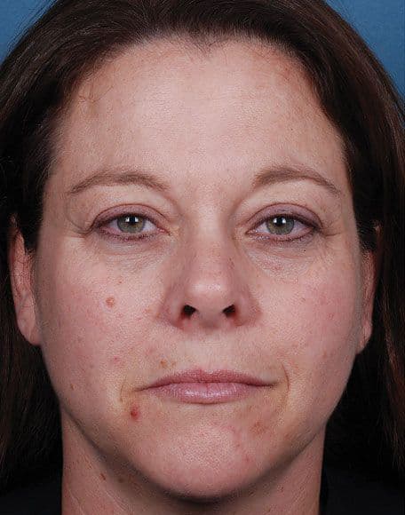 Skin case 3 before treatment