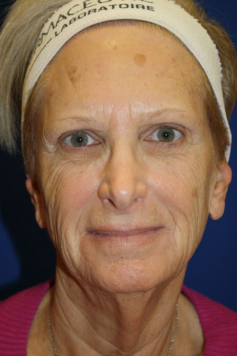 Skin case 4 before treatment