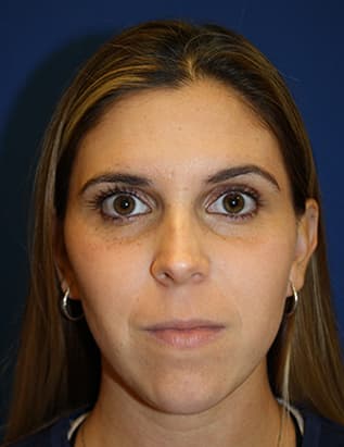 Skin case 5 after treatment