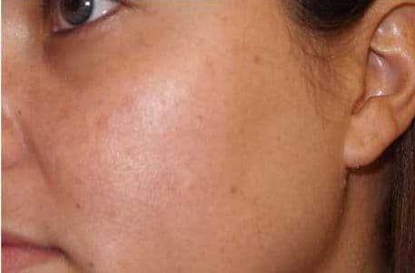 Skin case 6 after treatment
