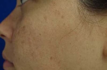 Skin case 6 before treatment