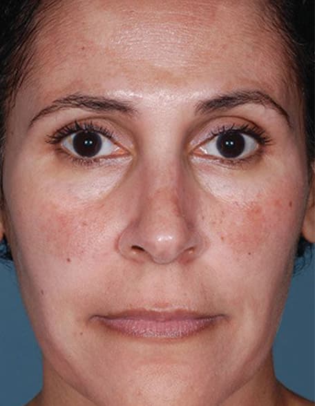Skin case 7 after treatment