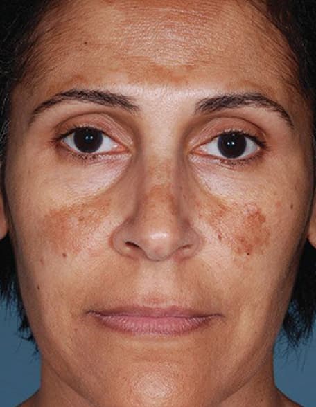 Skin case 7 before treatment