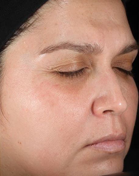 Skin case 8 after treatment