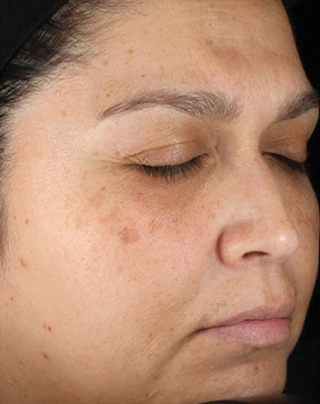 Skin case 8 before treatment