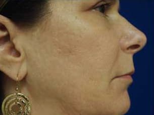 Skin case 9 after treatment