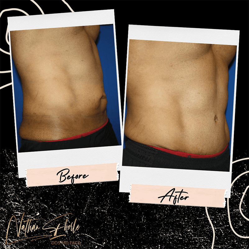 Tummy Tuck before and after case 1, actual patient at Weston Center for Plastic Surgery