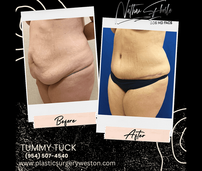 Tummy Tuck before and after case 10, actual patient at Weston Center for Plastic Surgery