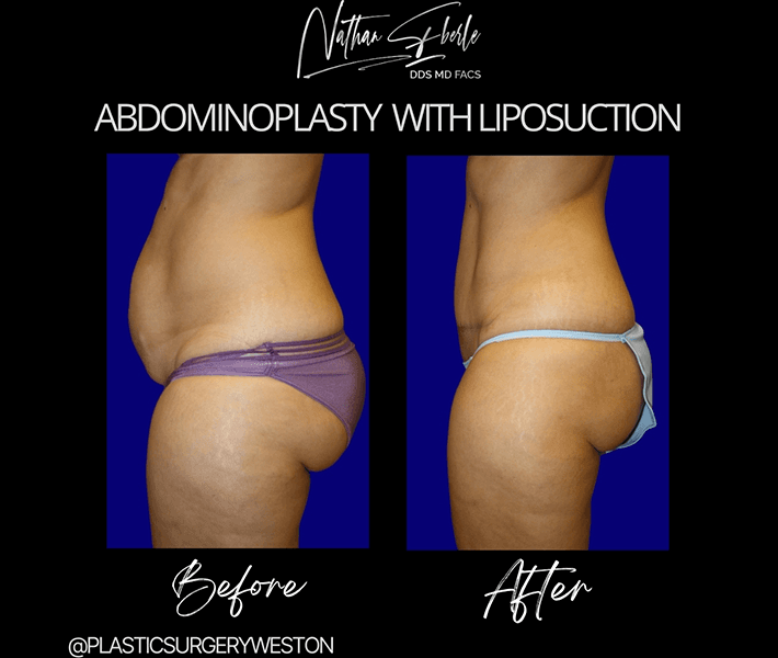 Tummy Tuck before and after case 12, actual patient at Weston Center for Plastic Surgery